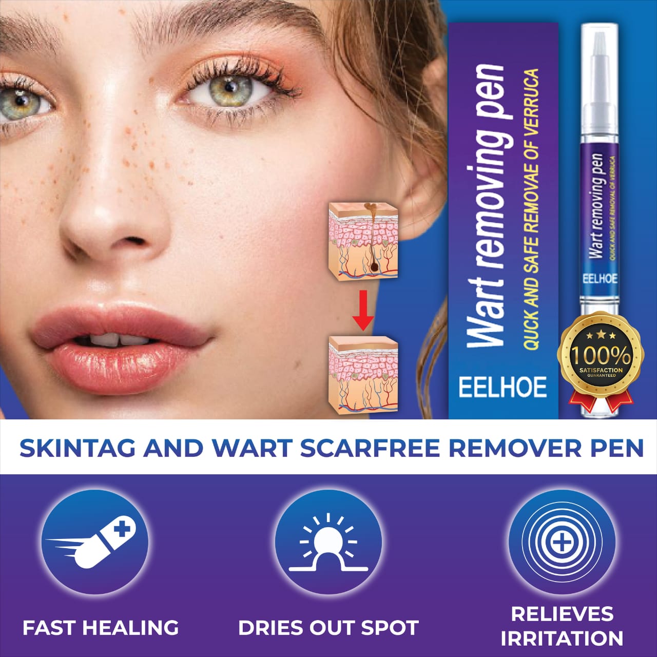 Wart Remover Gel Pen – Powerful Wart Removal Treatment for Hands – image 3