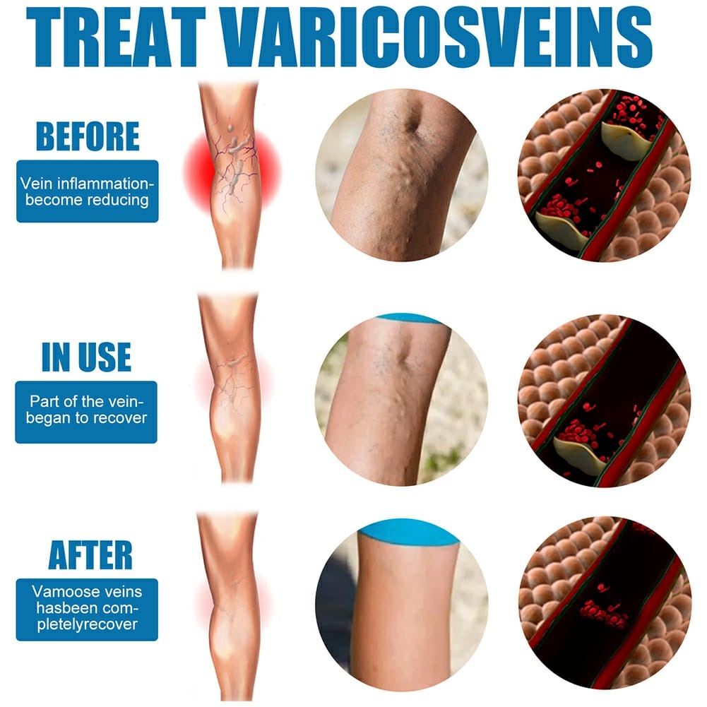 South Moon Varicose Veins Treatment Spray – image 2