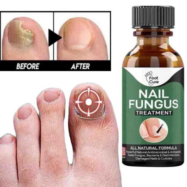 Nail Fungus Treatment Gel – Nail Repair Serum – image 4