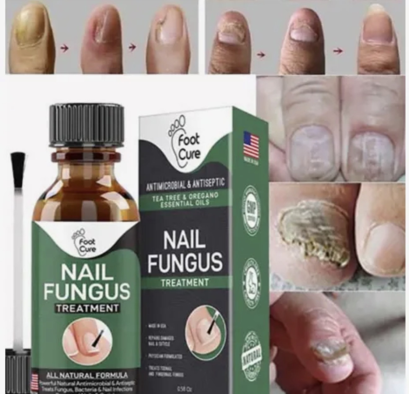 Fast Nail Fungus Treatment Serum 15ml All Natural Formula For Finger And Toenail Care – image 2